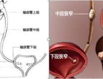 肾积水的原因,揭秘肾脏健康隐患